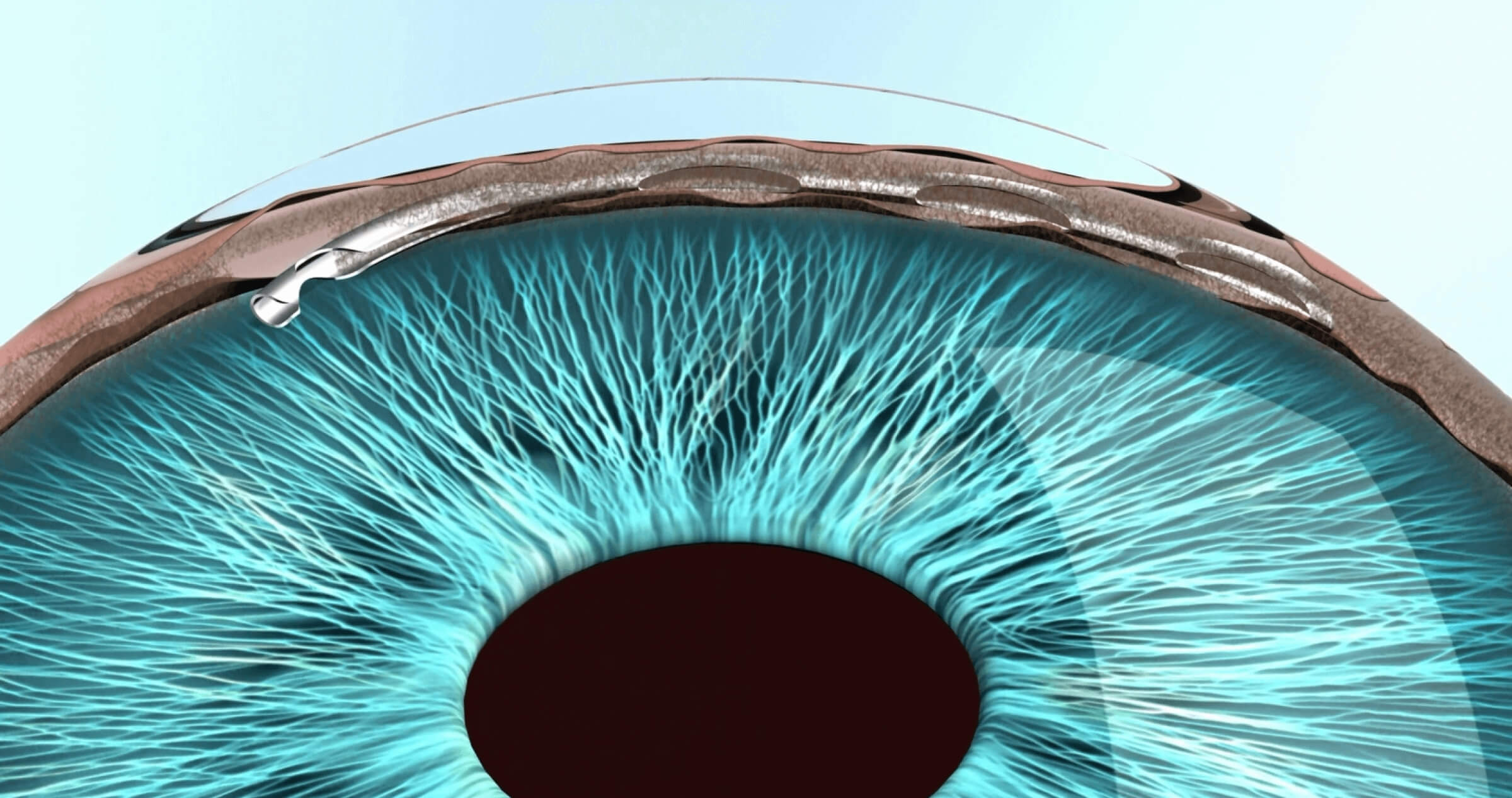 An illustration of an eye with the Hydrus stent implanted into Schlemm’s canal.