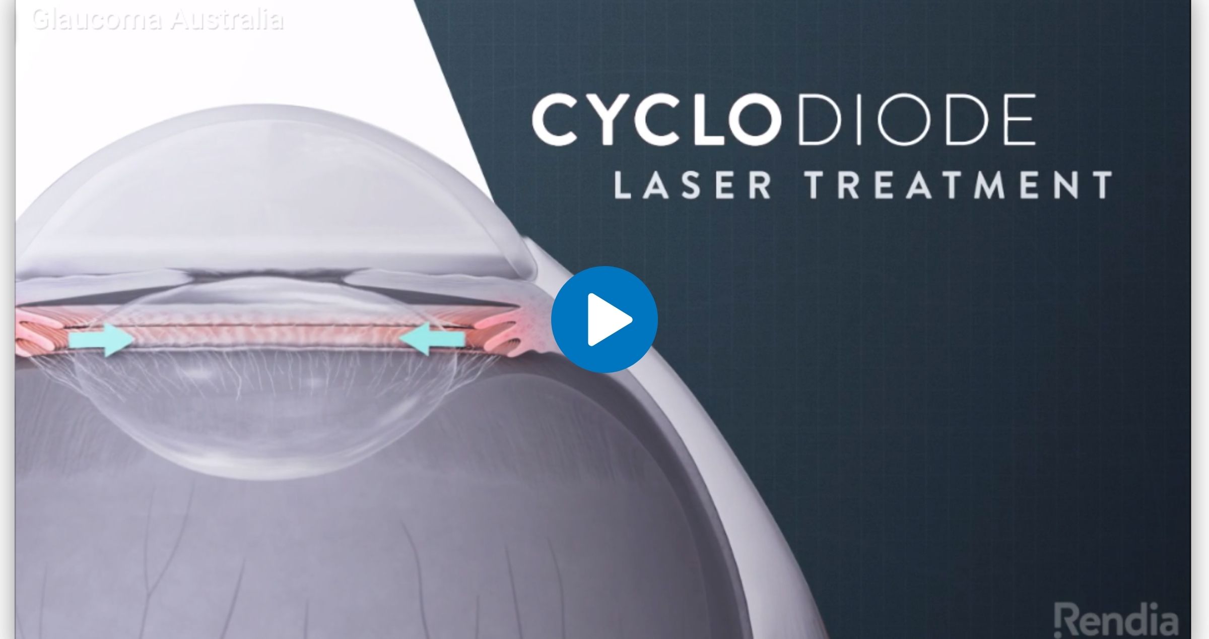 Cyclodiode Laser