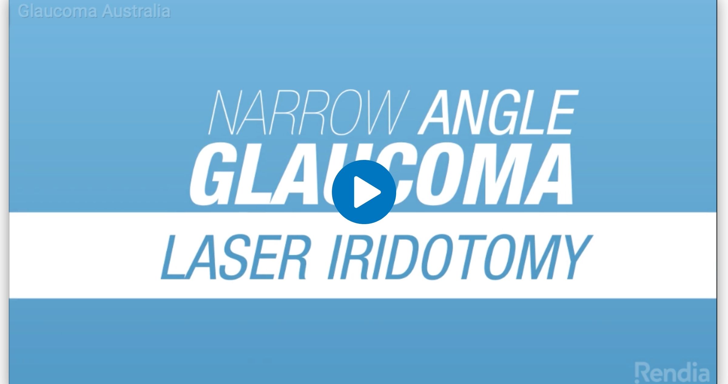 Laser Peripheral Iridotomy